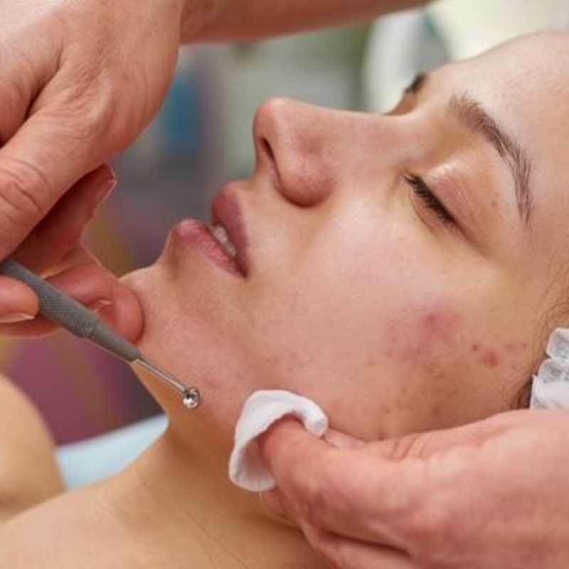 Acne Treatment | 3 Services